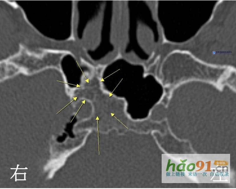 一側眼球無法轉動七旬老人患罕見蝶骨體感染