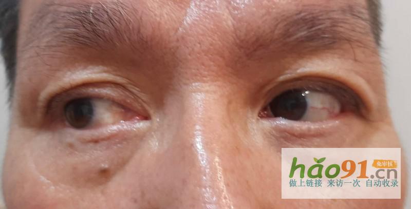 一側(cè)眼球無法轉(zhuǎn)動七旬老人患罕見蝶骨體感染